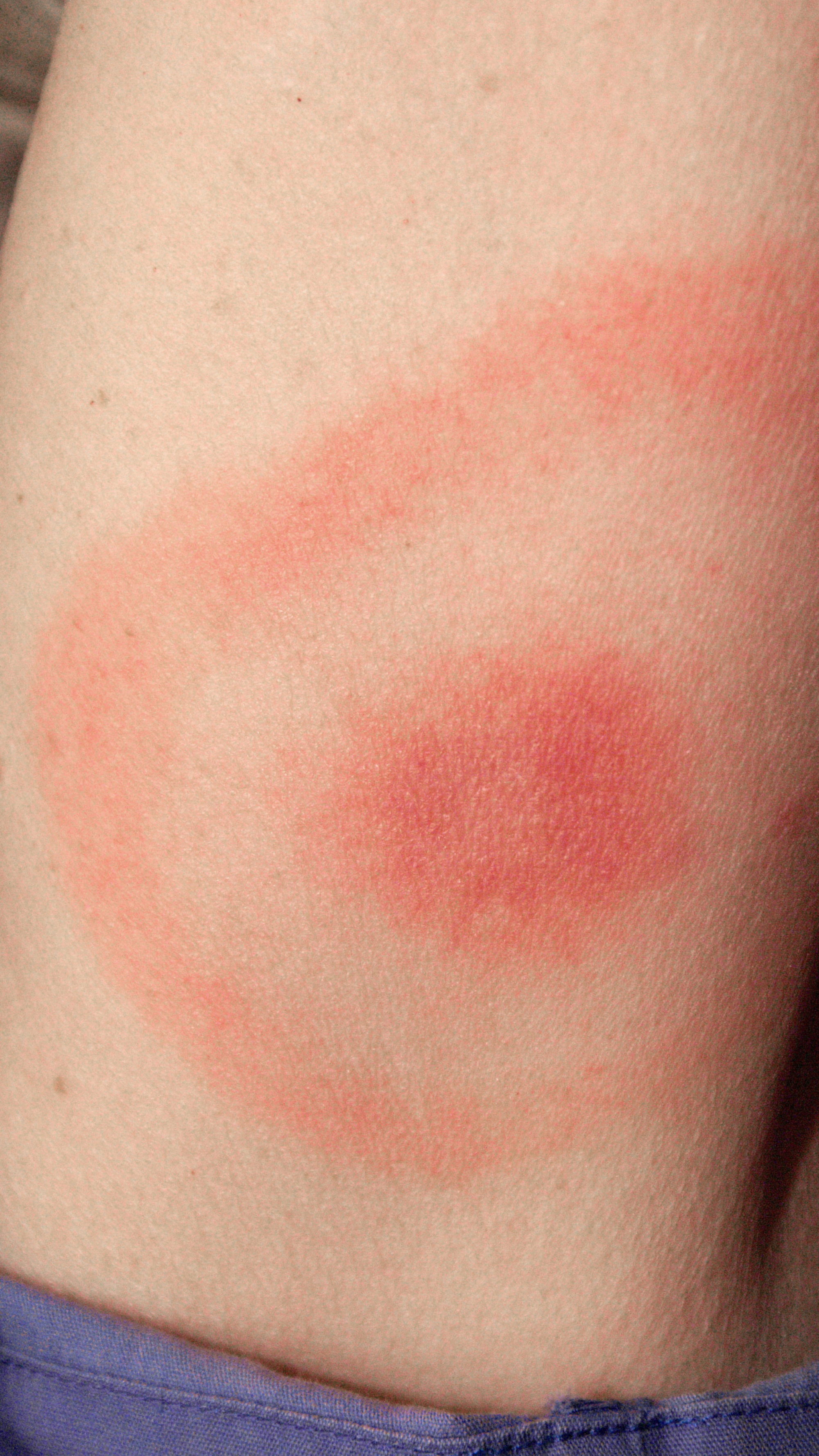 Erythema migrans kann in verschiedenen Formen auftreten